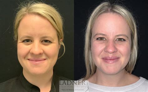 Brow Lift / Forehead Lift Before and After Photo Gallery | Denver, CO | Ladner Facial Plastic ...