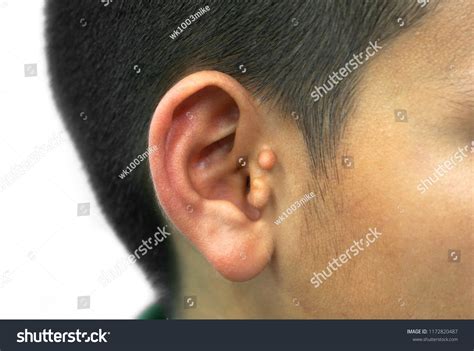 Skin Tag Ear