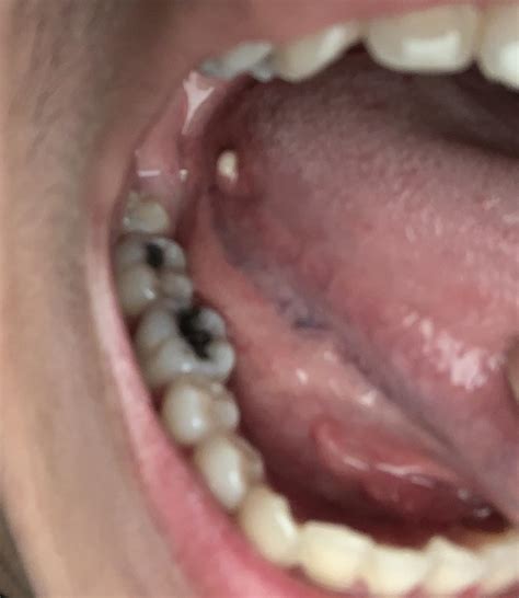 12 best r/askadentist images on Pholder | I got a discount option for dental implants from ...