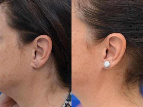 Earlobe Repair Before and After Pictures Case 88 | Charlotte, NC | Dilworth Facial Plastic Surgery