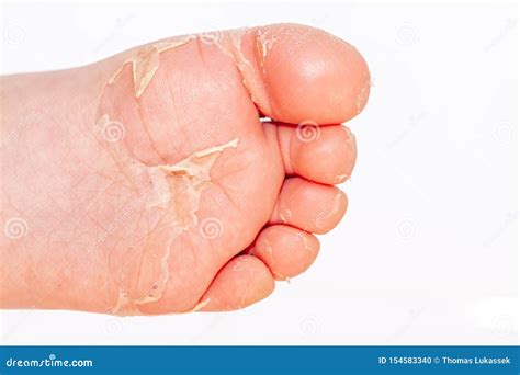 After the Red Rash and the Strawberry Tongue Caused by Scarlet Fever the Affected Skin Often ...