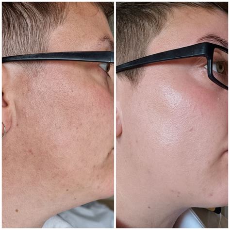 [Before&After] 3 Months Tretinoin : r/SkincareAddiction
