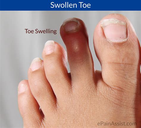 How To Cure A Swollen Toe - Treatmentstop21
