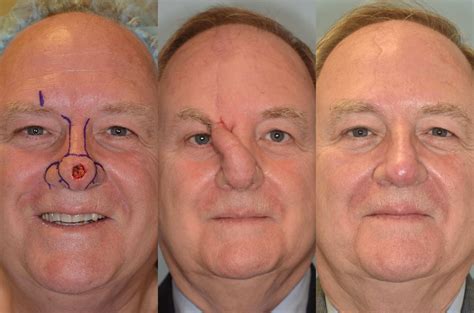 Skin Graft Healing Stages On Nose at Jayden Nobbs blog