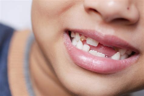 When Do Kids Start Losing Teeth? - Express Dentist