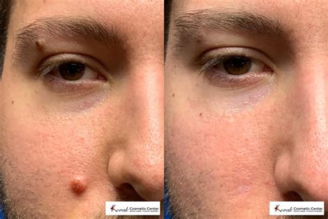 Mole Removal Before And After