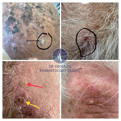 Actinic Keratosis: Causes, Symptoms, and Treatment Options – Dr Abdiaziz Dermatology Clinic.