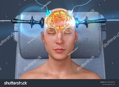 Elektrokonvülsif şok Tedavisi