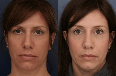 Blepharoplasty vs. Brow Lift Surgery - Blog - Ronald Schuster Plastic Surgery - Baltimore