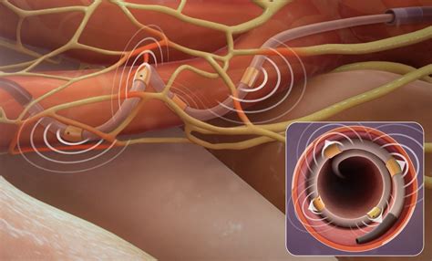 FDA approves another renal denervation system for hypertension