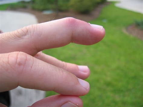 Build A Info About How To Tell If A Hand Is Broken - Westhoney53