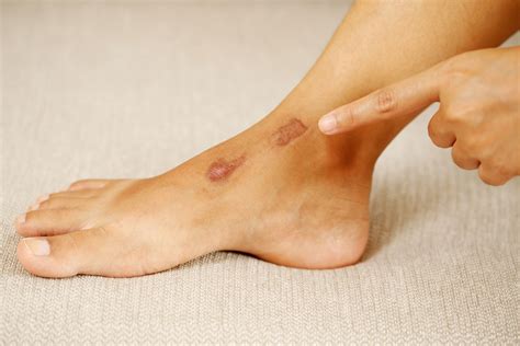 Icd 10 Code For Keloid Scar On The Foot Online | emergencydentistry.com