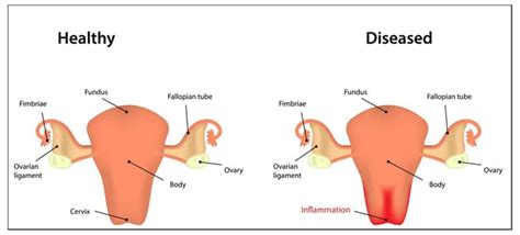 Itching in Private Parts (vaginal Itching) : Causes, Symptoms and Treatment
