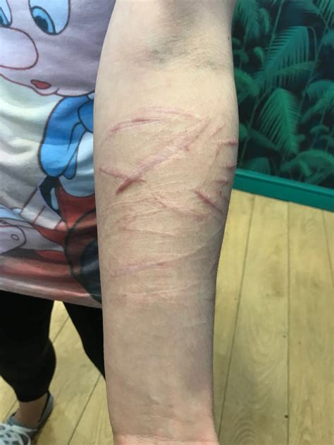 Keloid scar tattoo - Bronctattooaus.com