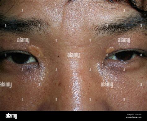 Xanthelasma deposits around a the eyes of a 28 year old Asian man. This is a collection of ...