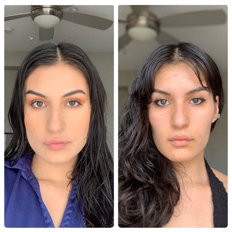 TMJ treatment changed my jaw/face shape : r/TMJ