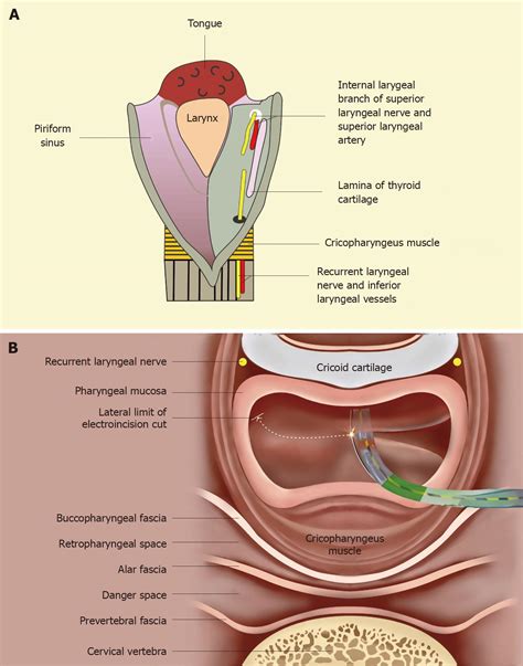 Tight near-total corrosive strictures of the proximal esophagus with ...