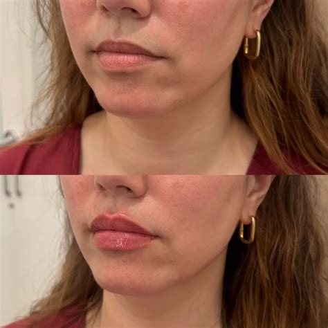 Lip Filler Before and After - Before After Journey