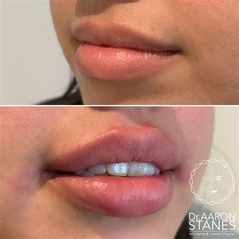 Lip Fillers | Инъекции губ, Увеличение губ, Губы