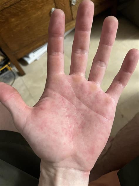 Itchy rash on palms : r/DiagnoseMe