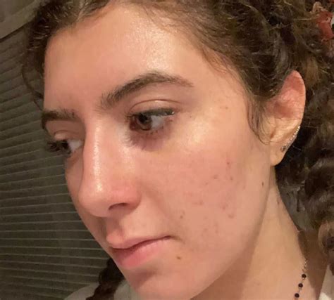 Adapalene Gel USP, 0.1% Acne Treatment | PanOxyl