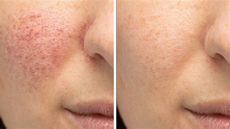 Rosacea Redness Laser Treatment