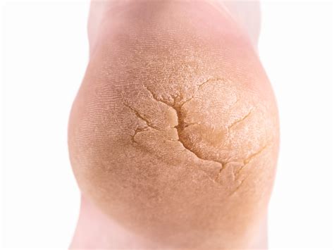 Callus On Ball Of Foot
