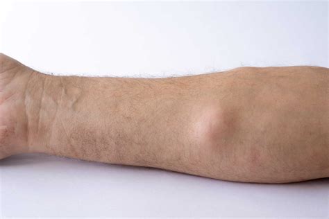 Lipomas vs. Liposarcoma - What’s the Difference?