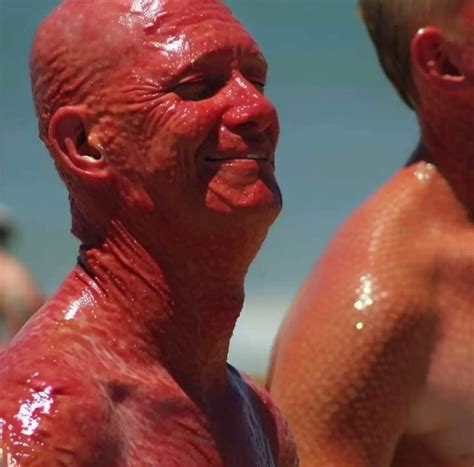 Turn-A-Kit | Extreme sunburn competition in Florida | Instagram
