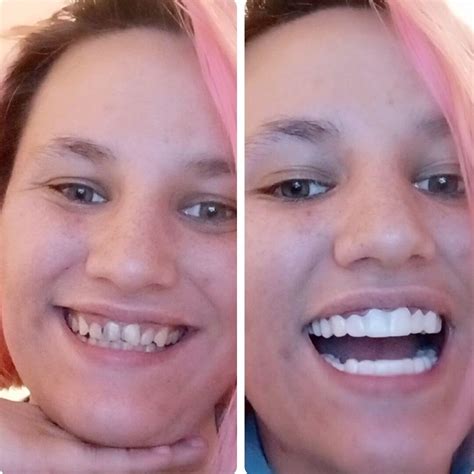 Pop On & Smile With Confidence - Pop On Veneers