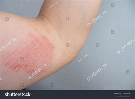 5,938 Bruise Color Images, Stock Photos & Vectors | Shutterstock