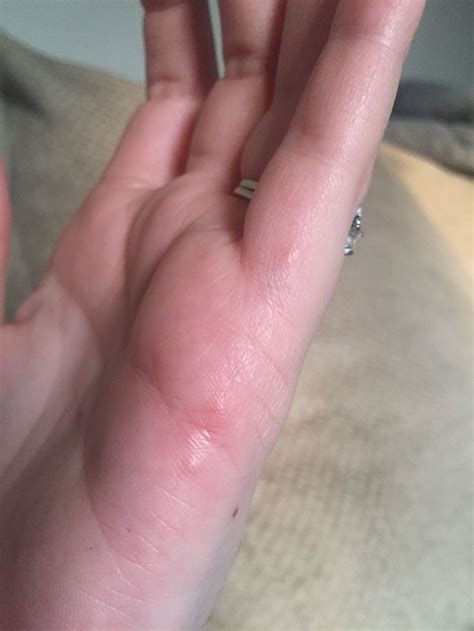 Shingles On Hands And Fingers