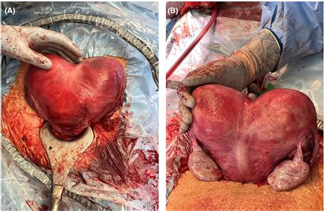 Dicavitary twin pregnancy in patient with bicornuate bicollis uterine ...