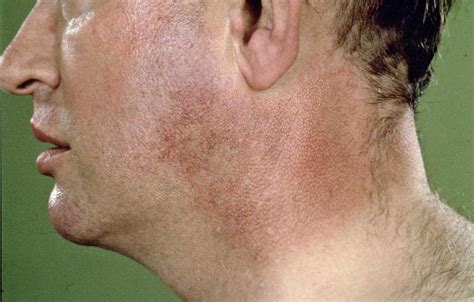 Poiquilodermia De Civatte Antes E Depois - RETOEDU