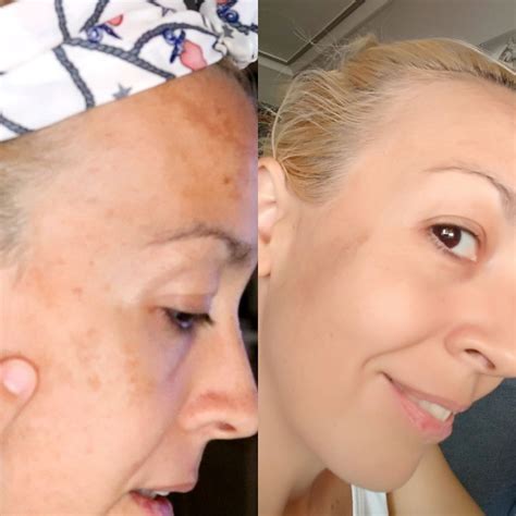 Cómo eliminar las manchas o paños de la piel | Natural y efectivo!