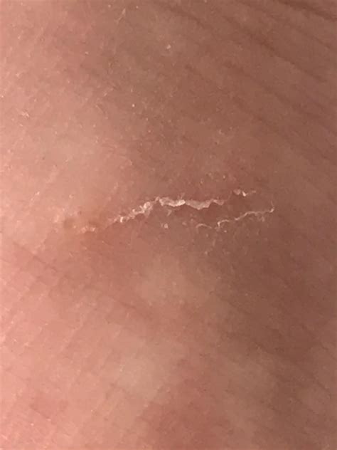 Does this look like a burrow? Ink test. : r/scabies