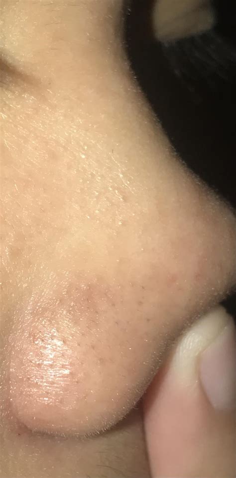 Anyone know how i can make the tiny bumps (sebaceous filaments??) on my nose less visible? and ...