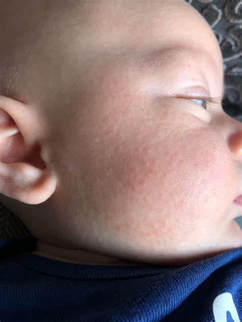baby drool rash or eczema - Talia Garris