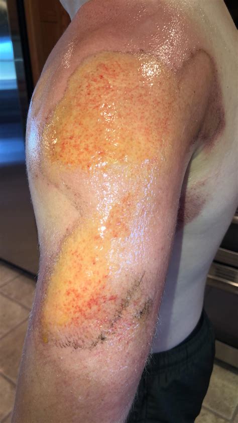 Surgery Wound Leaking Fluid at Mitchell Fredricksen blog