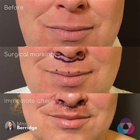 Lip Lift Surgery