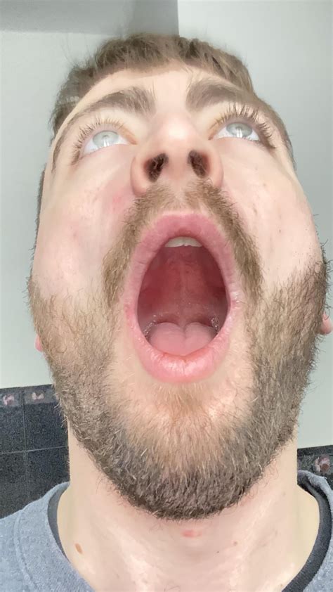 Lump on Roof of Mouth w/ Photos : r/TMJ