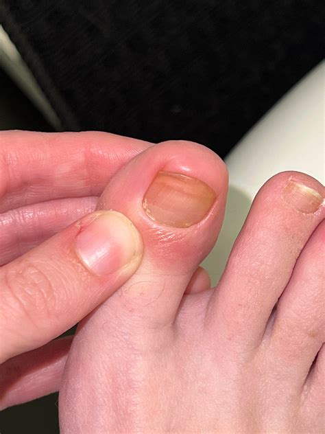 Retronychia after partial nail avulsion : r/Ingrown_Toenails