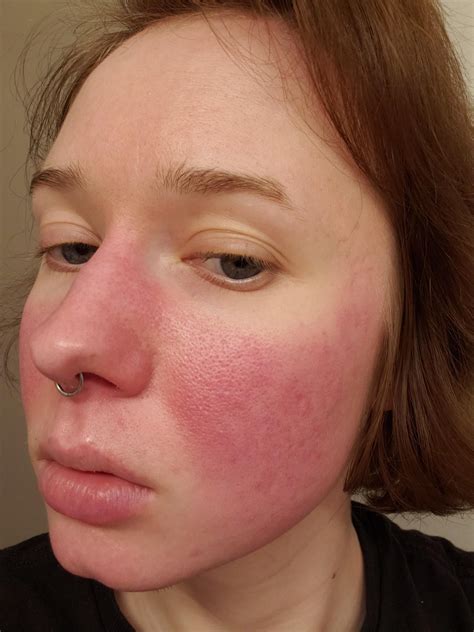 Weird redness / rash? on cheeks, nose and chin? : r/Skincare_Addiction