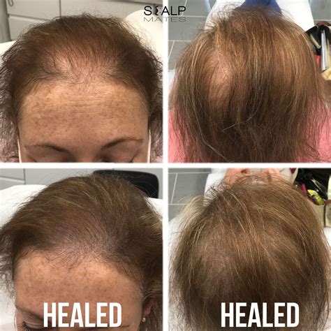 How To Cover Scalp For Thinning Hair at Andrew Randy blog