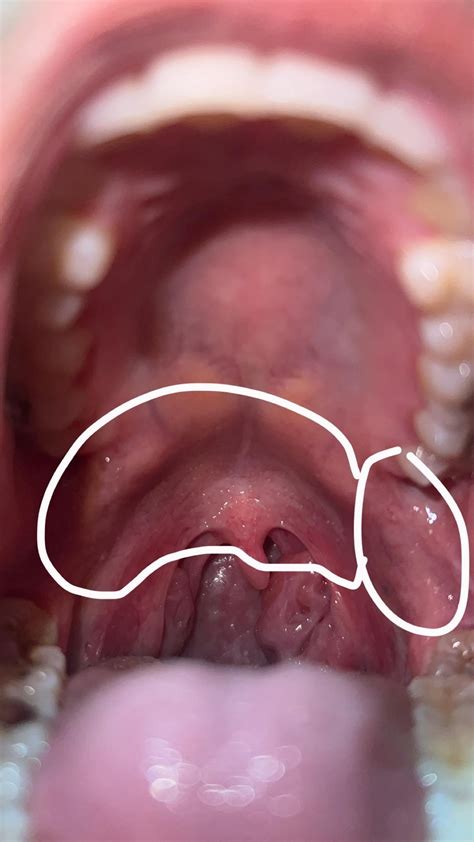 white bumps on the roof of my mouth/ back of throat : r/DiagnoseMe