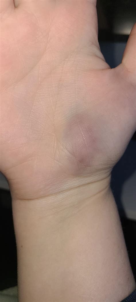 blood vessel popped at work randomly (no trauma to area prior) : r/mildlyinteresting