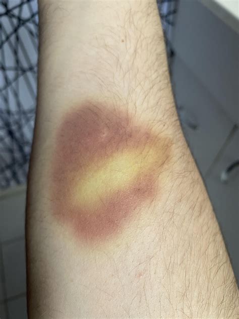 Bruise or blood clot? This bruise is freaking me out. I don’t remember injuring it. It’s kind of ...