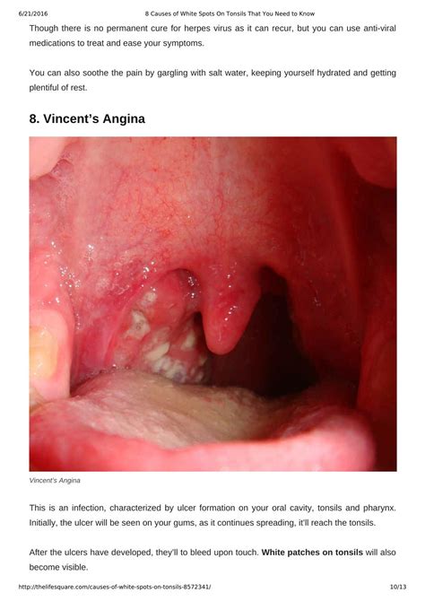 What Are The White Marks On My Tonsils at Dominic Johnson blog