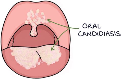 Candidiasis (Oral + Oesophageal) Flashcards | Quizlet