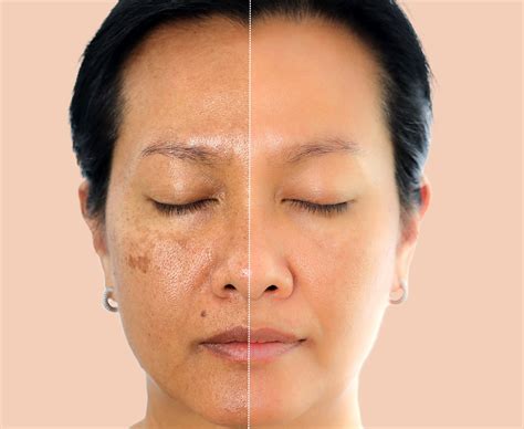 Our Top 5 Treatments for Hyperpigmentation - Aeternum Aesthetics